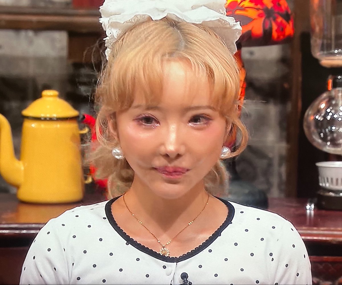 mtgjdpa's tweet photo. 【悲報】アゲハモデルさん、11回の整形手術

👁️全切開 目頭切開 グラマラスライン形成 目尻切開 埋没法✖️2回

👃鼻フル（小鼻縮小 鼻尖形成 人中短縮）

😕輪郭骨切り ヒアルロン酸 顔脂肪吸引

の大改造の結果、拘縮顔になり顔中に謎の膨らみと凹み、そして人中の壊し屋により唇が富士山になられる https://t.co/sWLalf8U8P