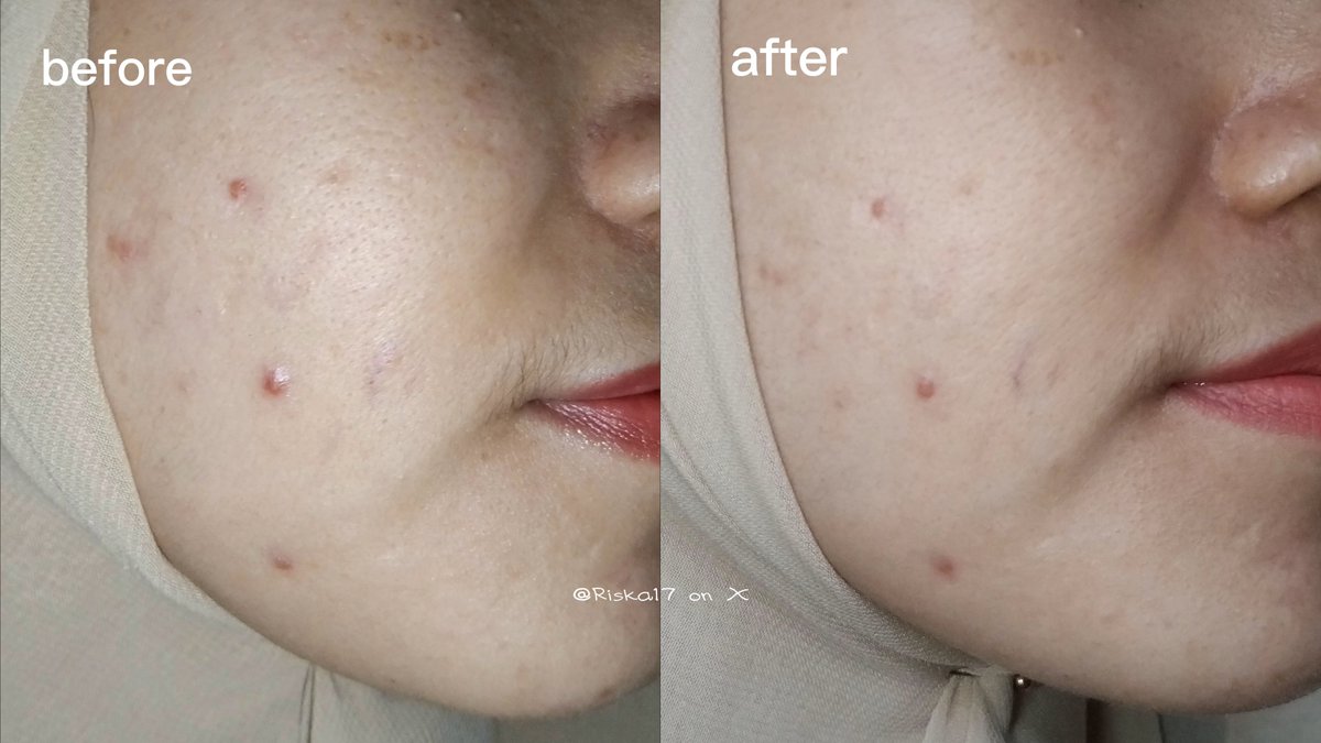 Riska17's tweet photo. jerawat kalo kesenggol sakit banget, makanya aku obsessed buat sembuhin!

dan ini hasilnya, yg sekarang tertinggal bekasnya aja.
sepakat sih, kalo lg proses penyembuhan pakenya skincare berminyak &amp; skincare berjerawat. https://t.co/4qwnJcPPNJ