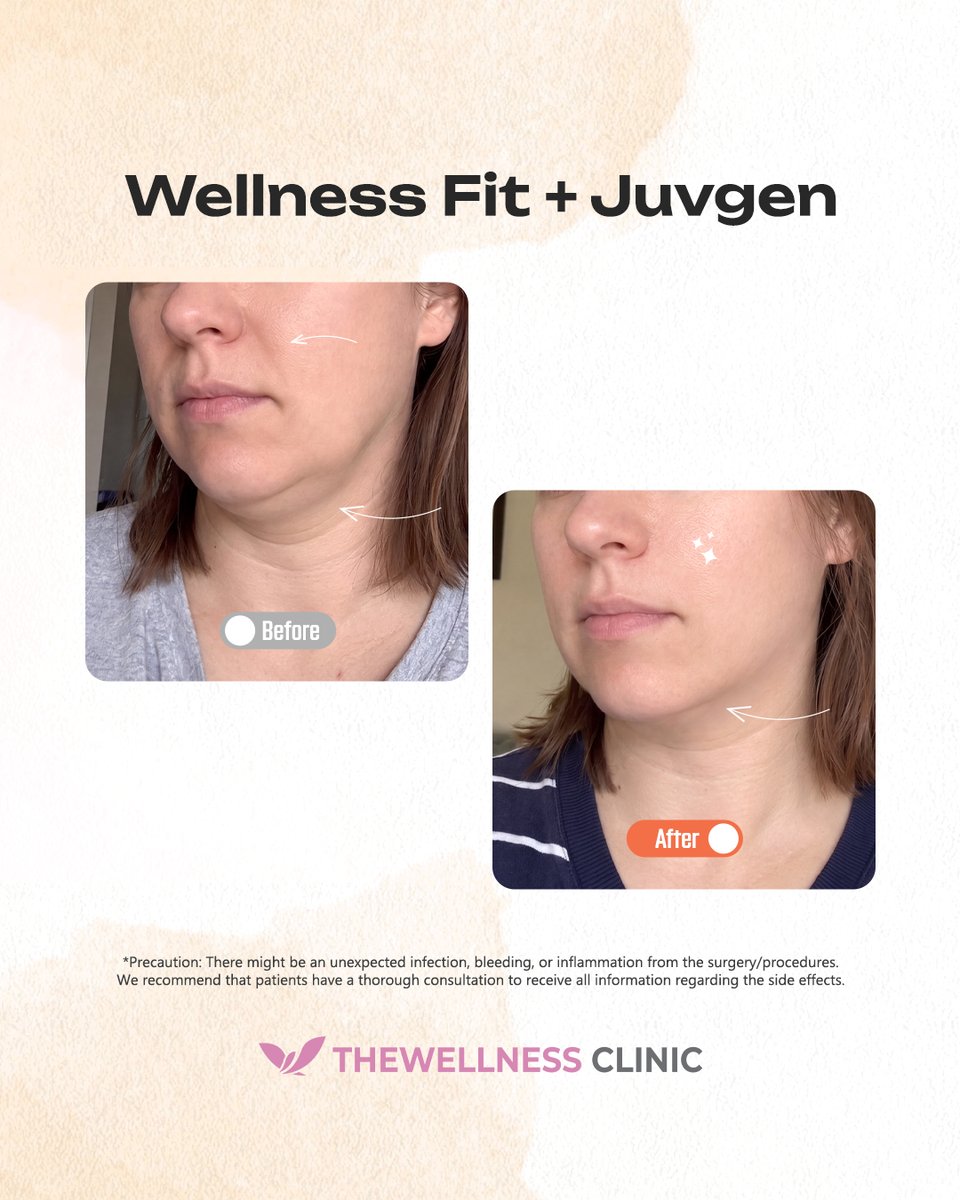 thewellnessen's tweet photo. 📢 Ready to contour your lower face and restore skin elasticity? 📩 DM for reservations &amp; inquiries
🕒 M–F 09:00–20:00 | Sat 09:00–16:00 | Sun 10:00–17:00 🏥 The Wellness Clinic 2F, Banpo Shopping Town Bldg. 8, 219 Sinbanpo-ro, Seocho-gu 

#TheWellnessClinic #WellnessFit #Juvgen https://t.co/x3EW1uPE7V