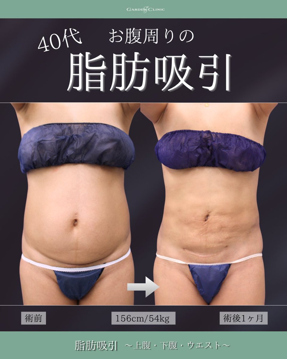GardenClinicNet's tweet photo. 40代女性：術後1ヶ月 
施術内容：お腹の脂肪吸引 
注意事項：腫れ、浮腫み、内出血 
●1部位 部分モニター220,000円 
●アキーセル1部位 通常料金+55,000円 
●VASER1部位 通常料金+55,000円 
↓脂肪吸引の詳細はこちらをチェック 
 https://t.co/4uppQUdJO4 https://t.co/FMG0qfs7Tt