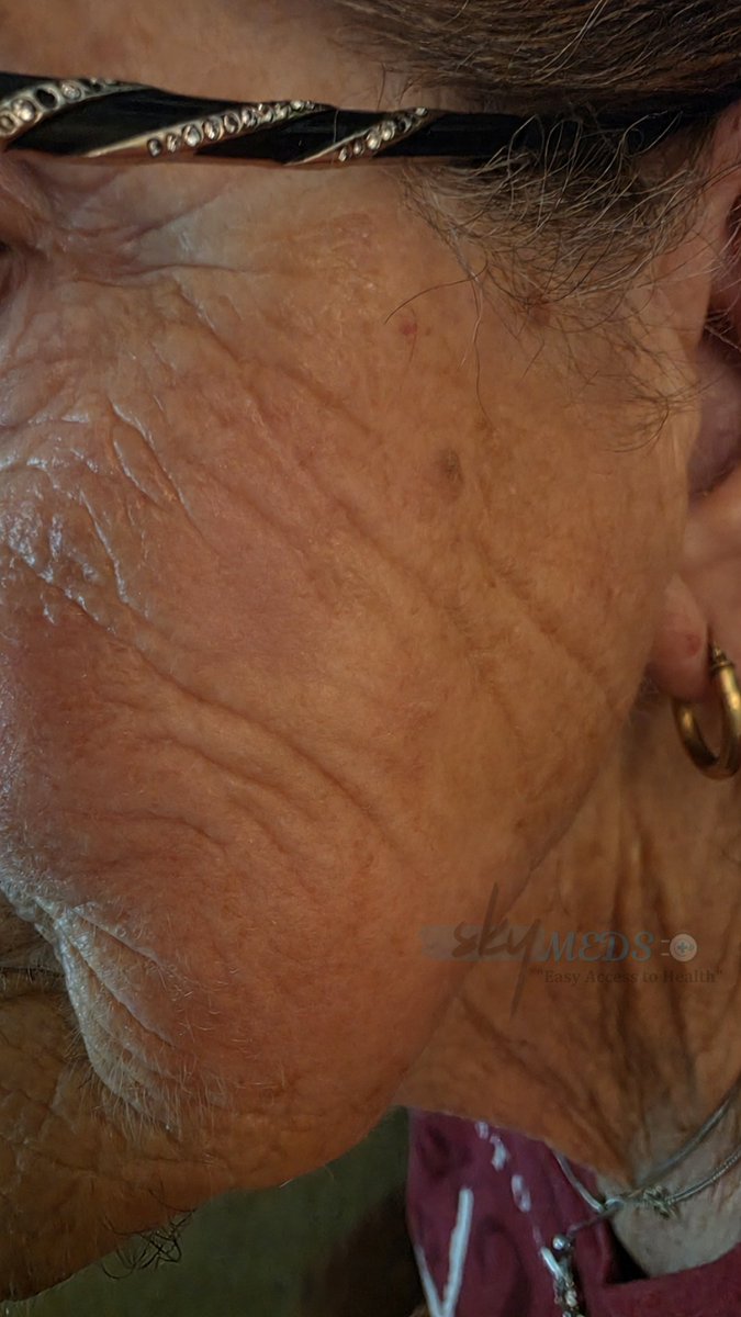 skymeds_store's tweet photo. "Mom has this spot on her cheek. Is the paste safe?"

That was the message from my sister last spring.

She'd noticed a rough, scaly patch on Mom's right cheek. It had been there for months. Growing slowly. The dermatologist said it was "suspicious" and wanted to biopsy it.

Mom was terrified. She's 78. Surgery on her face? No way.

I told her about the Ivermectin paste I'd been researching. She'd heard the jokes. "Isn't that horse stuff?"

I said, "Just try it on a tiny area first. Patch test."

She did. Two days, nothing. Then she started applying a pea-sized dab every morning and night.

Week 1: The redness started fading. She said it felt less itchy.

Week 2: The scaly patch began drying up. A crust formed. She was nervous – but I told her that was part of the process.

Week 3: The crust fell off. Underneath was smooth, healthy skin. Just a faint pink mark.

Week 4: The spot was completely gone. No scar. No surgery. No biopsy.

She called me crying. "It's gone. I can't believe it."

I can't either. But I've seen it now.

⚠️ Not medical advice – just our story. Always consult a doctor. But don't stop asking questions.

#Ivermectin #SkinSpot #Mom #HealingJourney