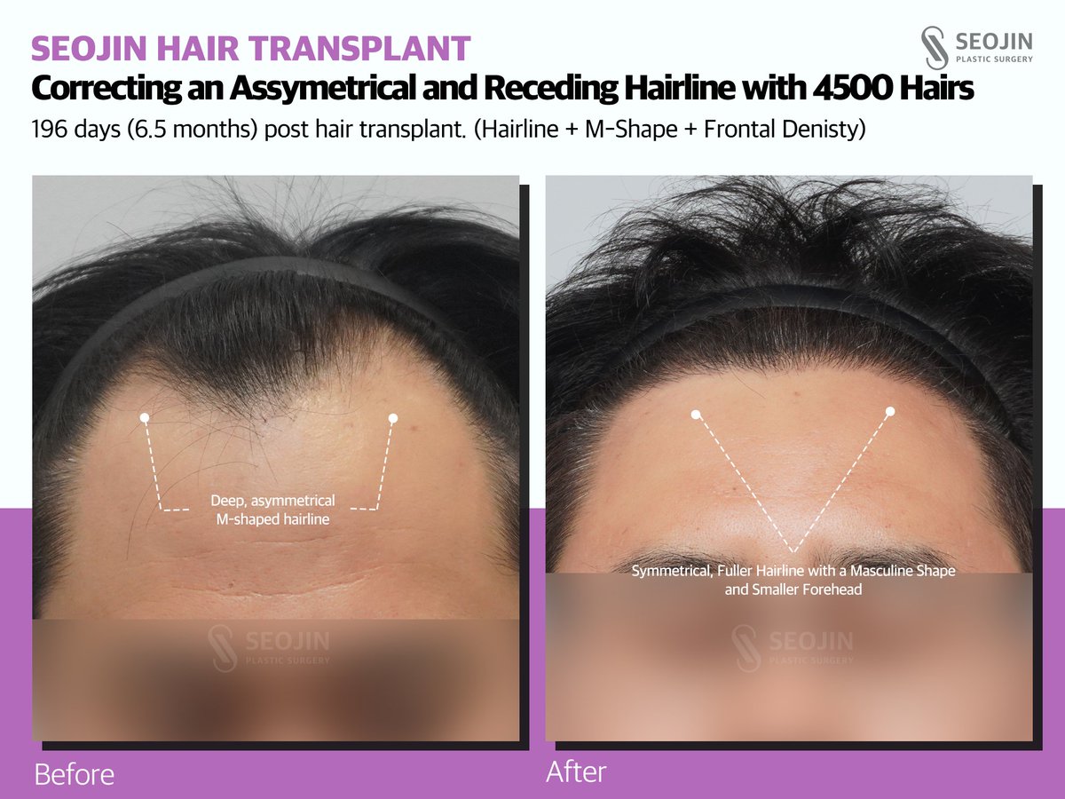 seojinps_eng's tweet photo. Precision makes all the difference. โจ
A custom-designed, masculine hairline created to perfectly frame the face while keeping it 100% natural.
๐ Seojin Plastic Surgery
#SeojinPS #HairLoss #Hairline #HairTransplant #BeforeAfter #MensHair #HairThinning #KoreanClinic #Seoul https://t.co/vRZUBJAlcr