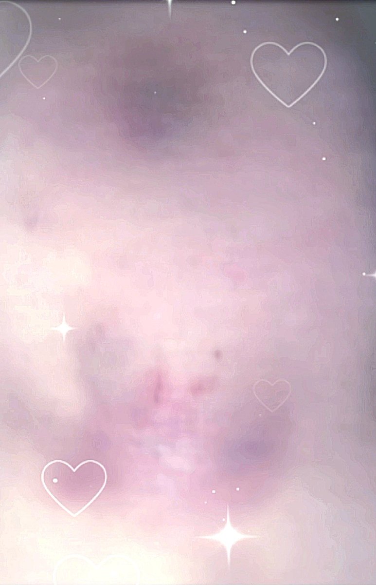 2ekiii's tweet photo. これは3日前緩やかに転んだ時にできた青タン♥️ https://t.co/eDKcMLFCym