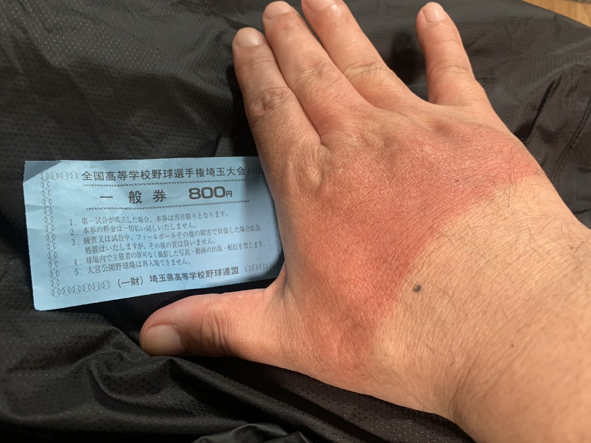 ChumiPapa's tweet photo. 昨日の観戦時、日焼け防止の為に帽子やタオルを被り長袖を着ていましたが手は日焼け止めを塗らず、結構焼けてしまいました https://t.co/FbxBIQGddH