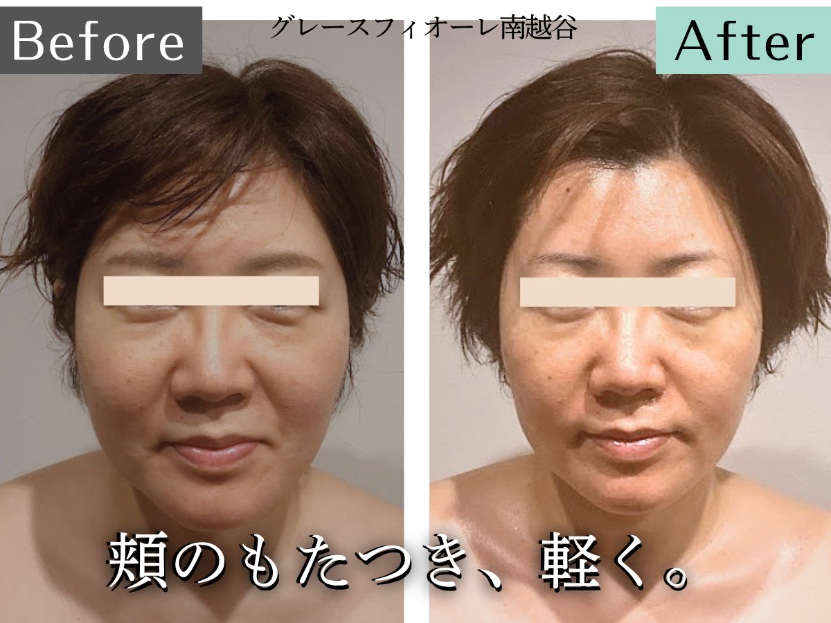 gracefiore44084's tweet photo. まだ見てない人・届いてない人へ！

ビフォーアフター一気に4人紹介！

ここまで変わるから59万人が感動。

眠れる頭蓋骨小顔矯正で、
「夏を楽しめる自分」へ。

レイクタウンの隣駅の南越谷駅から1分。
グレースフィオーレ南越谷です。 https://t.co/xgqn7bhbCh