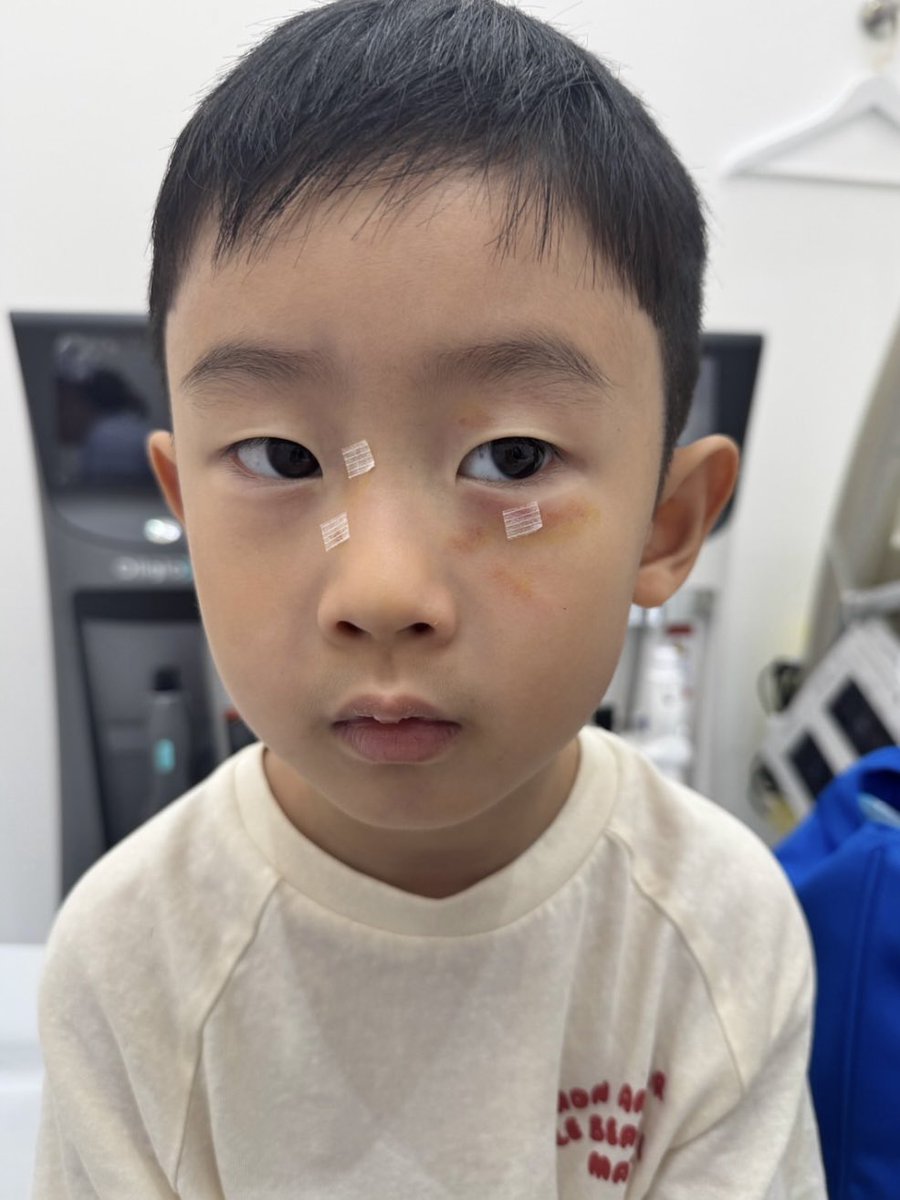 pttt236's tweet photo. อมกกก น้องโรฮาลูกชายคุณอ้วนรังสิต โดนทำร้ายจนเป็นแผลเต็มหน้าเลย คุณอ้วนลงไอจีว่า

“เหตุการณ์เกิดขึ้นเมื่อวาน แม่ลูกไปเล่นสวยสนุกในห้างแถวนนทบุรี (พ่อไม่ได้ไปด้วย) ขณะที่โรฮากำลังเดินเข้าแทมโพลีนก็มีเด็กอายุไม่ต่ำกว่า 10 ขวบ เดินเข้ามาข่วนหน้าโดยไม่มีเหตุผล และเดินตามข่วนต่อโดยที่โรฮาไม่ได้ทำอะไรเลยและไม่ได้ตอบโต้ ใครรู้จักโรฮาจะรู้เลยว่าโรฮาเป็นเด็กเรียบร้อย ไม่มีทางที่จะไปทำอะไรใครก่อนหรือสู้กับใคร หลังจากเห็นคลิปแล้วก็เป็นแบบนั้นจริงๆ”

คุณอ้วนบอกว่าคู่กรณีเป็นเด็กป่วยจิต เอาจริงๆถ้าป่วยผู้ปกครองควรดูแลให้ดีกว่านี้อะ น้องโดนจนเป็นแผลเยอะมากเลย 😭

Cr: Auan_rangsit (ig)
