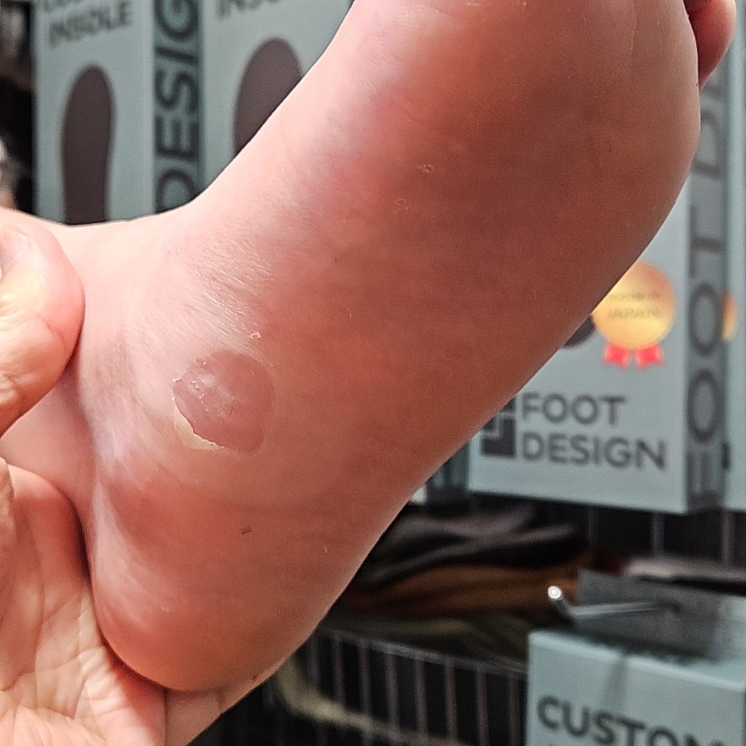 FOOTLAB_INSOLE's tweet photo. 「滑らないインソール」で足裏の皮が剥けることも…。原因は過度な摩擦。バッシュはソールでグリップ、インソールは足の動きをサポートするのが正解。FOOTDESIGNは可動性を保ちながら安定を提供します。詳しく→ https://t.co/jPllbIJBOQ #FOOTLAB #フットデザイン #インソール #バスケ #足裏の痛み https://t.co/PJqkdZEH9c