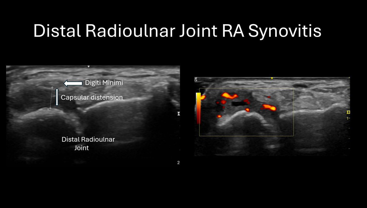 MillwardLuke's tweet photo. This distal radioulnar joint  an essential place to scan for RA synovitis. You can often pick up subtle changes at this joint and is one not to miss. 
hashtag#rheumatoidarthritis hashtag#distalradioulnarjoint hashtag#wristpain hashtag#synovitis hashtag#diagnosticultrasound https://t.co/aeYARgMU9S