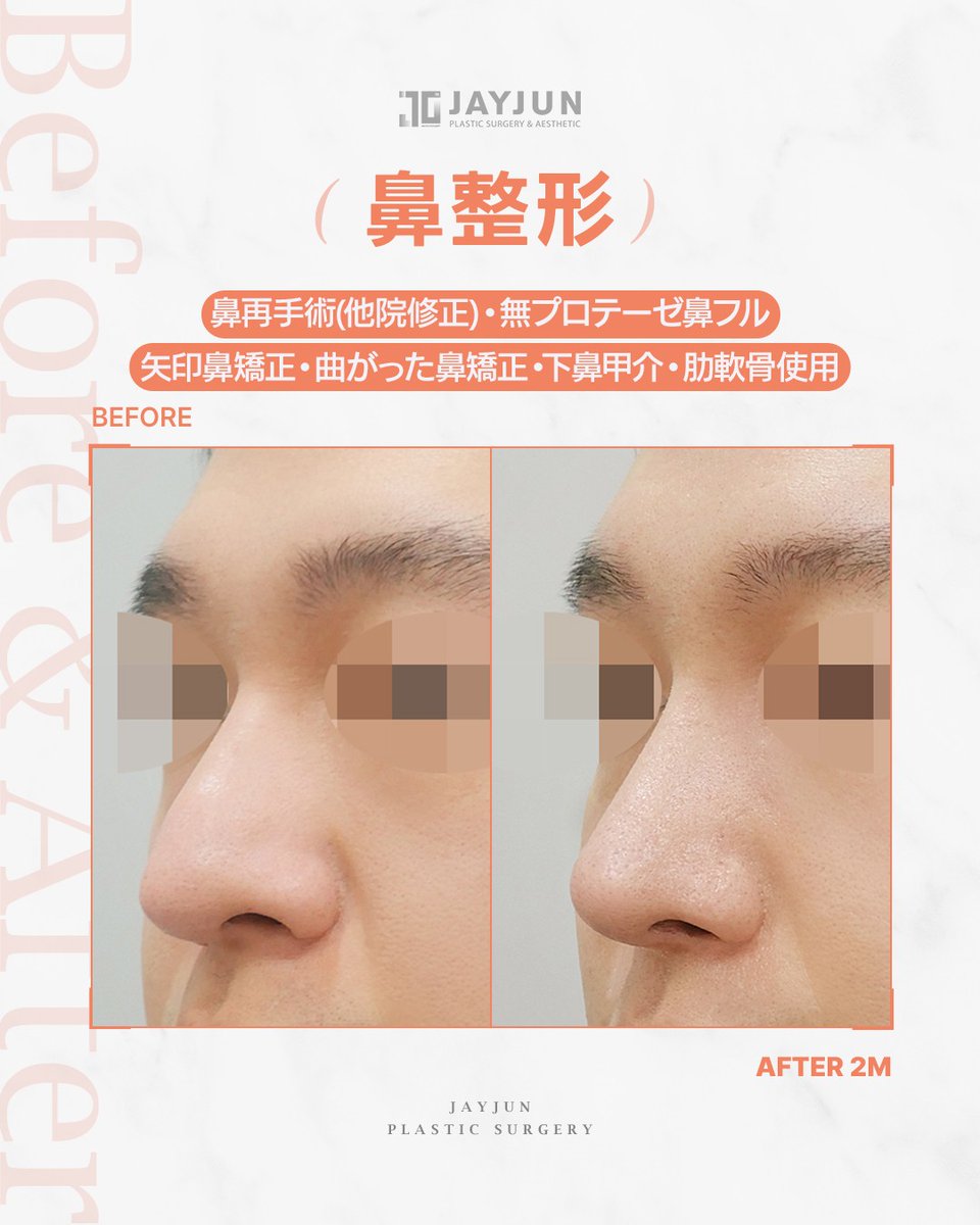 jayjun_jpn's tweet photo. ✦ JAYJUNメンズ鼻再手術｜他院修正｜無プロテーゼ鼻フル ✦

『前回の鼻整形後の違和感を整えたい』
『鼻先の丸みや曲がりを自然に修正したい』

今回の症例は、
他院修正／無プロテーゼ鼻フル。

矢印鼻・曲がった鼻・鼻先の丸みを確認し、
肋軟骨を使用して、鼻筋から鼻先までのラインを再設計しました。

プロテーゼを使用せず、
もともとの骨格や皮膚の厚みに合わせて整えることで、
派手すぎない自然な横顔へ。

術後2ヶ月の時点でも、
鼻先の重さが軽減され、横顔の印象がよりすっきりと整っています👃🏻✨

男性の鼻再手術は、
「さらに高さを足す」のではなく、
前回の違和感の原因を見極めて整えることが大切です。

別角度の症例写真は画像でご確認ください。

━━━━━━━━━━━━━━━━
🏥 JAYJUN美容外科｜ソウル江南
🇯🇵 日本人通訳常駐
📩 LINE：https://t.co/5uZjGbmAmQ
━━━━━━━━━━━━━━━━

※腫れ・仕上がり・ダウンタイムには個人差があります。

#鼻再手術 #鼻修正 #他院修正 #無プロテーゼ鼻整形 #曲がった鼻 #矢印鼻 #鼻先修正 #メンズ鼻整形 #男性鼻整形 #韓国鼻整形 #江南美容外科 #渡韓整形
