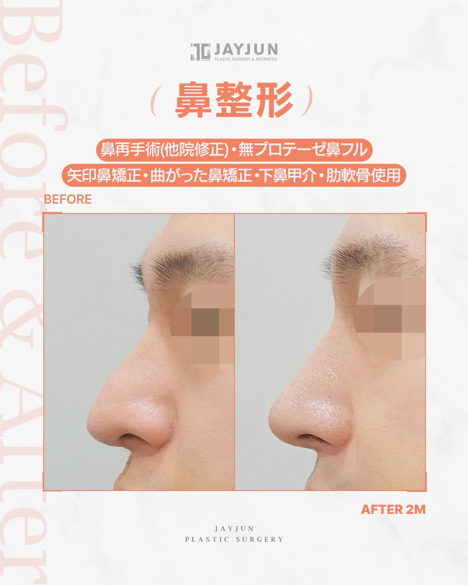 jayjun_jpn's tweet photo. ✦ JAYJUNメンズ鼻再手術｜他院修正｜無プロテーゼ鼻フル ✦

『前回の鼻整形後の違和感を整えたい』
『鼻先の丸みや曲がりを自然に修正したい』

今回の症例は、
他院修正／無プロテーゼ鼻フル。

矢印鼻・曲がった鼻・鼻先の丸みを確認し、
肋軟骨を使用して、鼻筋から鼻先までのラインを再設計しました。

プロテーゼを使用せず、
もともとの骨格や皮膚の厚みに合わせて整えることで、
派手すぎない自然な横顔へ。

術後2ヶ月の時点でも、
鼻先の重さが軽減され、横顔の印象がよりすっきりと整っています👃🏻✨

男性の鼻再手術は、
「さらに高さを足す」のではなく、
前回の違和感の原因を見極めて整えることが大切です。

別角度の症例写真は画像でご確認ください。

━━━━━━━━━━━━━━━━
🏥 JAYJUN美容外科｜ソウル江南
🇯🇵 日本人通訳常駐
📩 LINE：https://t.co/5uZjGbmAmQ
━━━━━━━━━━━━━━━━

※腫れ・仕上がり・ダウンタイムには個人差があります。

#鼻再手術 #鼻修正 #他院修正 #無プロテーゼ鼻整形 #曲がった鼻 #矢印鼻 #鼻先修正 #メンズ鼻整形 #男性鼻整形 #韓国鼻整形 #江南美容外科 #渡韓整形