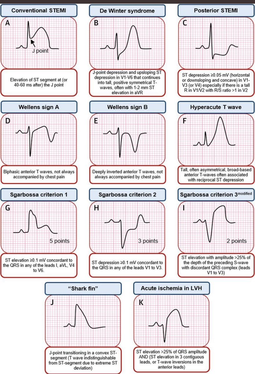 TrackYourHeart's tweet photo. STEMI Equivalents https://t.co/87vBwmBI9C