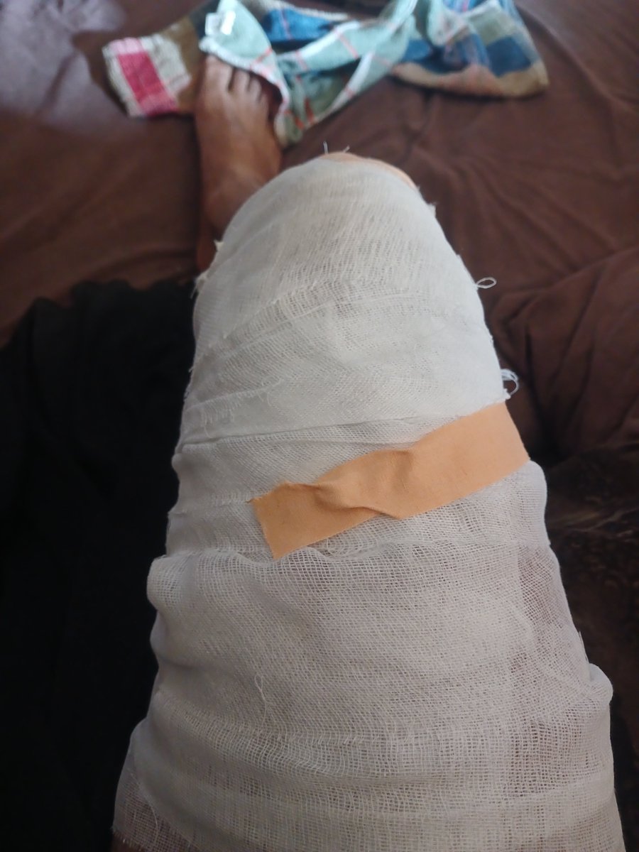 BelalFromGaza's tweet photo. Today I suffered burns while cooking over an open fire because we have no cooking gas. I am the sole provider for my family and urgently need $150 for burn ointment. Any donation or share could save us🙏💔
https://t.co/MNnDflPgSu

@hsnyldrm1979 @oliveegirl @hayalizati @c4rkovski https://t.co/7OYjBNbqeW