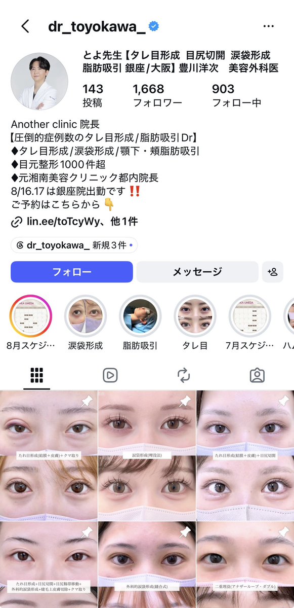2024_0406's tweet photo. 豊川先生のタレ目と小顔脂肪吸引のキャンペーン破格すぎん⁉️⁉️😂😂😂
目元整形の仕上がり可愛すぎて目のイメージしかなかったけど、脂肪吸引も顎下ﾍﾟﾀﾍﾟﾀめちゃ綺麗😱❤️‍🔥

☑️たれ目形成（皮膚切開）▶︎ 88,000
☑️たれ目形成（結膜切開▶︎ 148,000
☑️たれ目形成（結膜+皮膚切開）▶︎ 198,000
☑️脂肪吸引（ほほ）▶︎ 88,000
☑️脂肪吸引（顎下）▶︎ 88,000
☑️脂肪吸引（ほほ+顎下）▶︎ 98,000
※ 全てモニター

リアルなDT経過の写真まで載せてくれててめっちゃ参考になるから、気になる人は@dr_toyokawa かインスタ覗いてみてね〜！！

【PR】【アナザークリニック】