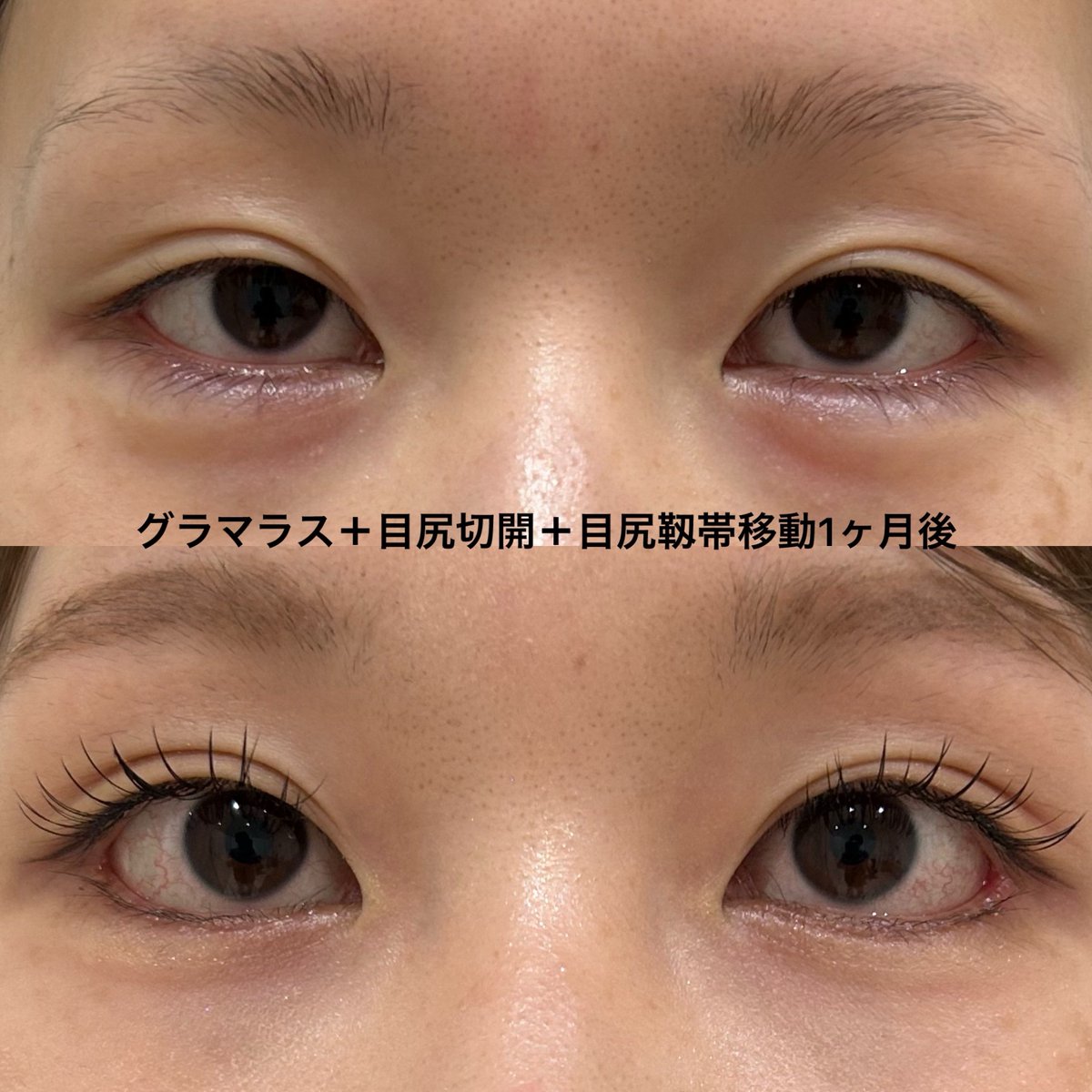 eternalprince08's tweet photo. 自然に目を大きくしたいご希望でした
ナチュラルな仕上がりを目指しました https://t.co/xzoithd8DG