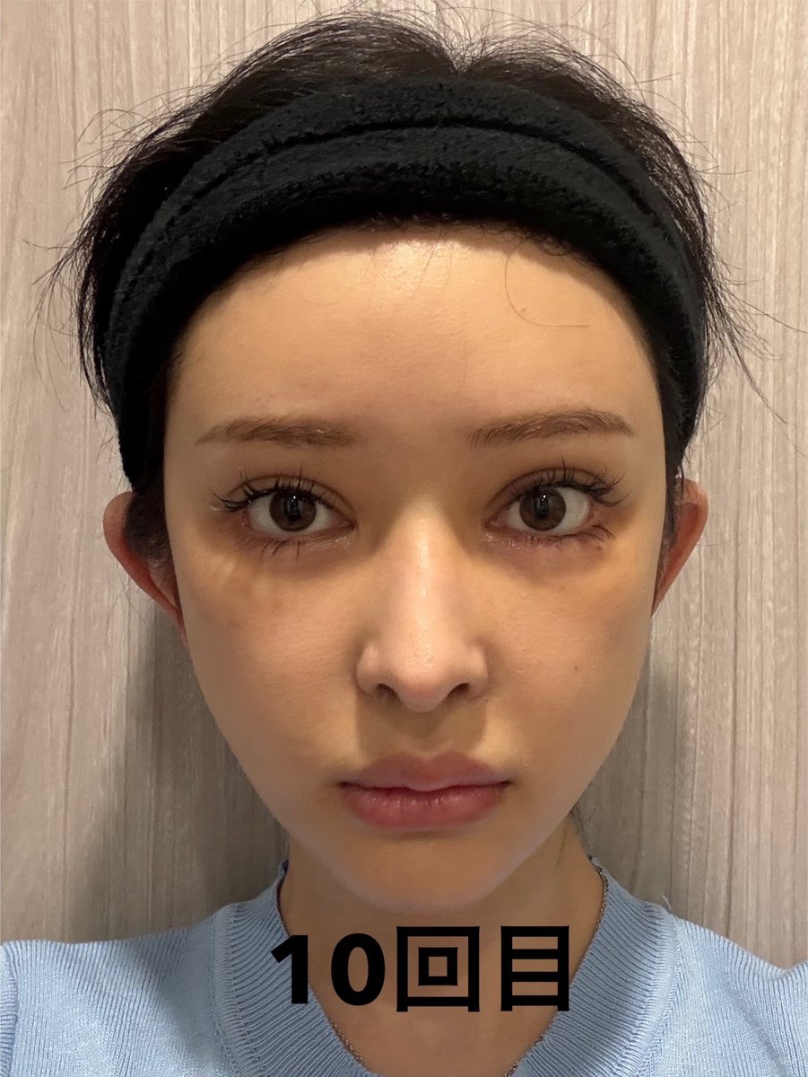 riku3chan's tweet photo. オンダリフトは通えば通うほど顔小さくなってくる！
私がいってるライトクリニックは1回20000円で出力数驚きの14万Jだからコスパ最高🤟💞
顔小さくなったねってめっちゃ言われる https://t.co/jLPNHFvRmE