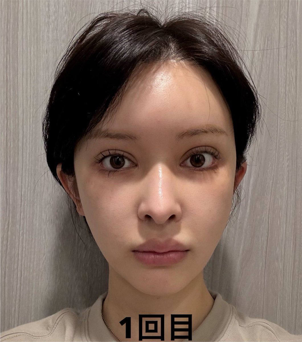 riku3chan's tweet photo. オンダリフトは通えば通うほど顔小さくなってくる！
私がいってるライトクリニックは1回20000円で出力数驚きの14万Jだからコスパ最高🤟💞
顔小さくなったねってめっちゃ言われる https://t.co/jLPNHFvRmE