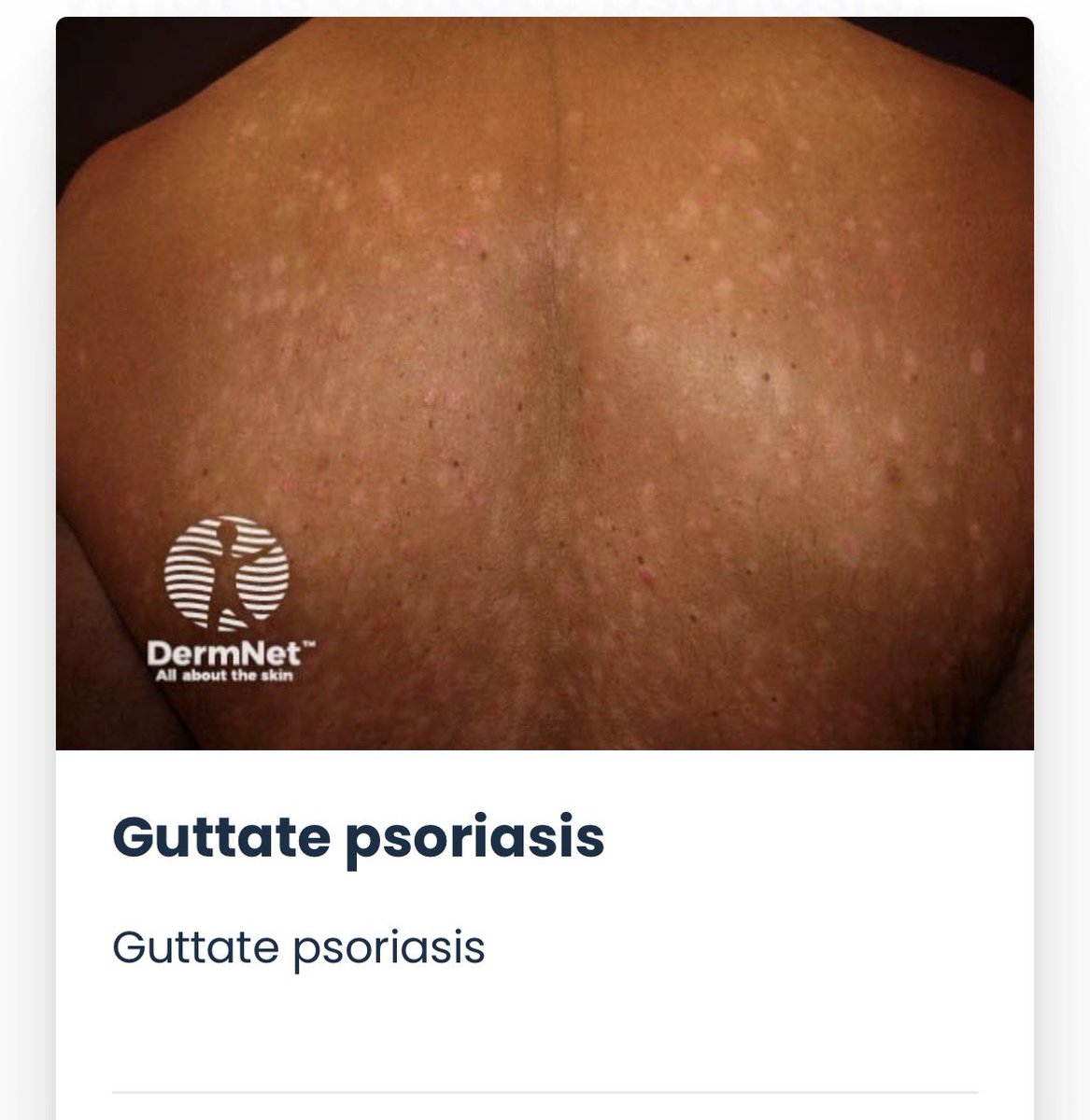 123mMohammed's tweet photo. 🚨 الصدفية النقطية
 (Guttate Psoriasis)

_ أحد أنواع الصدفية الحادة
_ تظهر على شكل بقع صغيرة وردية أو حمراء مع قشور خفيفة تشبه قطرات المطر

_ تنتشر غالبًا في في الصدر ، الظهر  والأطراف، وقد تصيب فروة الرأس والوجه والأذنين بشكل أخف

🔸 من الأكثر عرضة ؟

_ الأطفال و المراهقين
_ قد تكون أول ظهور للصدفية اللويحية المزمنة عند المريض
_ قد تصيب مرضى لديهم صدفية مزمنة مسبقًا

🔸 الأسباب والمحفزات :

_ غالبًا تظهر بعد 1–2 أسبوع من التهاب الحلق بالعقديات (Streptococcal pharyngitis)
_ قد تحدث بعد التهابات فيروسية مثل كوفيد-19 أو فيروس كوكساكي
_ وجود استعداد وراثي يزيد من احتمالية الإصابة

🔸 الأعراض :

_ ظهور سريع خلال أيام
_ بقع عديدة صغيرة (<1 سم)
_ لونها وردي أو أحمر مع قشور رقيقة
_ تتركز في الصدر ، الظهر الذراعين والساقين
_ قد يصاحبها حكة بدرجات متفاوتة

🔸 التشخيص :

_ يعتمد غالبًا على الفحص السريري
_ البحث عن عدوى العقديات عند الاشتباه بها
_ خزعة جلدية إذا كان التشخيص غير واضح

🔸 التشخيصات المتشابهة 
 (Differential Diagnosis) :

_ النخالية الوردية (Pityriasis rosea)
_ النخالية الحزازية المزمنة (Pityriasis lichenoides chronica)
_ الزهري الثانوي (Secondary syphilis)

🔸 العلاج :

_ علاج التهاب العقديات بالمضاد الحيوي عند وجود عدوى نشطة
_ المضاد الحيوي غالبًا لا يسرّع اختفاء الطفح الجلدي
_ الترطيب (Emollients)
_ العلاج الضوئي بالأشعة فوق البنفسجية ضيقة النطاق (NB-UVB)
_ قد تُستخدم العلاجات البيولوجية في الحالات الشديدة أو المستمرة
_ استئصال اللوزتين قد يُنظر فيه عند تكرار النوبات المرتبطة بالتهاب اللوزتين

🔸 الإنذار :

_ غالبًا تختفي خلال 3–4 أشهر حتى بدون علاج
_ قد تتكرر مع تكرار التهاب العقديات
_ حوالي 12.5% من المرضى قد تتطور لديهم لاحقًا الصدفية اللويحية المزمنة (Chronic Plaque Psoriasis)، ونصف هذه الحالات تظهر خلال السنة الأولى

♦️المصدر : DermNet NZ