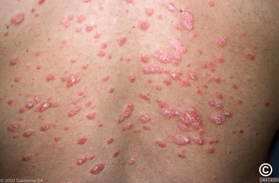 123mMohammed's tweet photo. 🚨 الصدفية النقطية
 (Guttate Psoriasis)

_ أحد أنواع الصدفية الحادة
_ تظهر على شكل بقع صغيرة وردية أو حمراء مع قشور خفيفة تشبه قطرات المطر

_ تنتشر غالبًا في في الصدر ، الظهر  والأطراف، وقد تصيب فروة الرأس والوجه والأذنين بشكل أخف

🔸 من الأكثر عرضة ؟

_ الأطفال و المراهقين
_ قد تكون أول ظهور للصدفية اللويحية المزمنة عند المريض
_ قد تصيب مرضى لديهم صدفية مزمنة مسبقًا

🔸 الأسباب والمحفزات :

_ غالبًا تظهر بعد 1–2 أسبوع من التهاب الحلق بالعقديات (Streptococcal pharyngitis)
_ قد تحدث بعد التهابات فيروسية مثل كوفيد-19 أو فيروس كوكساكي
_ وجود استعداد وراثي يزيد من احتمالية الإصابة

🔸 الأعراض :

_ ظهور سريع خلال أيام
_ بقع عديدة صغيرة (<1 سم)
_ لونها وردي أو أحمر مع قشور رقيقة
_ تتركز في الصدر ، الظهر الذراعين والساقين
_ قد يصاحبها حكة بدرجات متفاوتة

🔸 التشخيص :

_ يعتمد غالبًا على الفحص السريري
_ البحث عن عدوى العقديات عند الاشتباه بها
_ خزعة جلدية إذا كان التشخيص غير واضح

🔸 التشخيصات المتشابهة 
 (Differential Diagnosis) :

_ النخالية الوردية (Pityriasis rosea)
_ النخالية الحزازية المزمنة (Pityriasis lichenoides chronica)
_ الزهري الثانوي (Secondary syphilis)

🔸 العلاج :

_ علاج التهاب العقديات بالمضاد الحيوي عند وجود عدوى نشطة
_ المضاد الحيوي غالبًا لا يسرّع اختفاء الطفح الجلدي
_ الترطيب (Emollients)
_ العلاج الضوئي بالأشعة فوق البنفسجية ضيقة النطاق (NB-UVB)
_ قد تُستخدم العلاجات البيولوجية في الحالات الشديدة أو المستمرة
_ استئصال اللوزتين قد يُنظر فيه عند تكرار النوبات المرتبطة بالتهاب اللوزتين

🔸 الإنذار :

_ غالبًا تختفي خلال 3–4 أشهر حتى بدون علاج
_ قد تتكرر مع تكرار التهاب العقديات
_ حوالي 12.5% من المرضى قد تتطور لديهم لاحقًا الصدفية اللويحية المزمنة (Chronic Plaque Psoriasis)، ونصف هذه الحالات تظهر خلال السنة الأولى

♦️المصدر : DermNet NZ