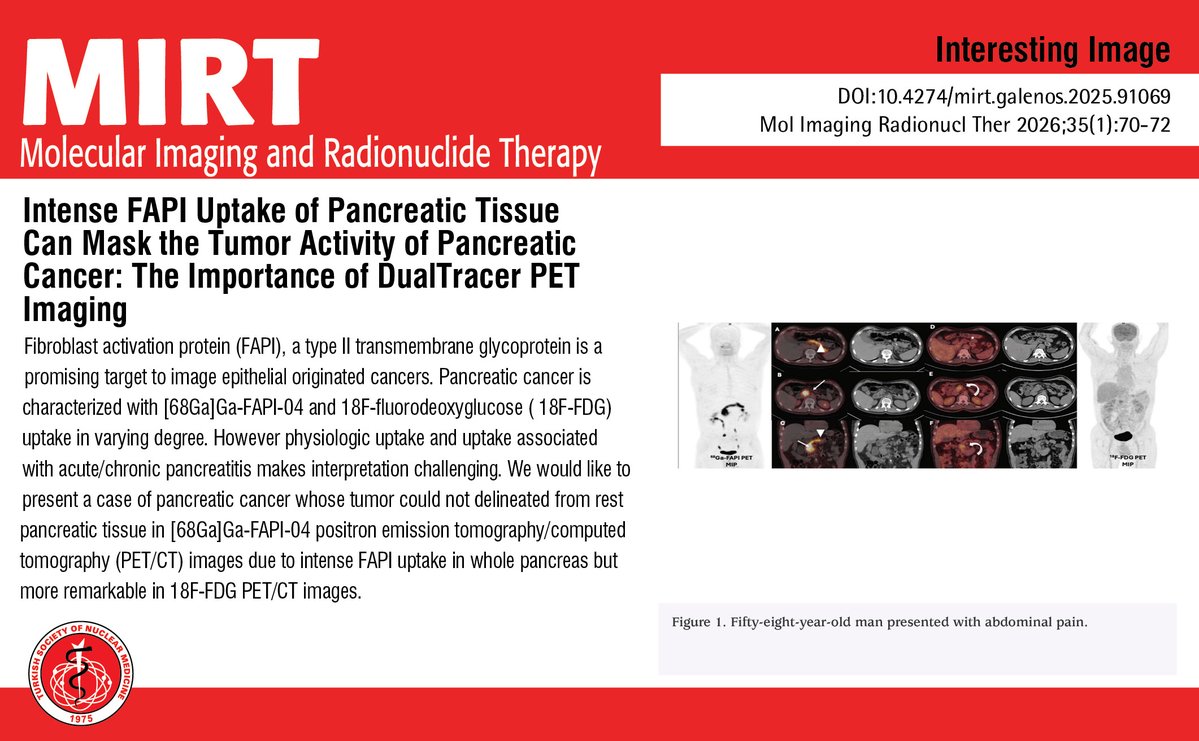 MIRTOfficial's tweet photo. Intense FAPI Uptake of Pancreatic Tissue Can Mask the Tumor Activity of Pancreatic Cancer: The Importance of DualTracer PET Imaging
You can see the free full text of the research by Elife Akgün et al.
Link : https://t.co/eoW6Y6fN32
#Gallium68 #pancreatic #cancer #FDG https://t.co/auXxRHBK1N