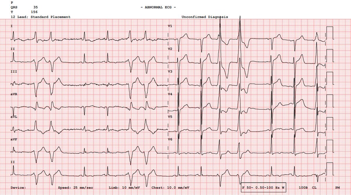 yasermd96's tweet photo. 54M, history of CABG×4 performed 3 months ago. He presented to the outpatient cardiology clinic for a routine follow up visit. He is asymptomatic and in good general condition.

1 Pre CABG ECG and 2 outpatient follow up ECG:

Would these post ECGs concern you? https://t.co/rSEMaEgxtx