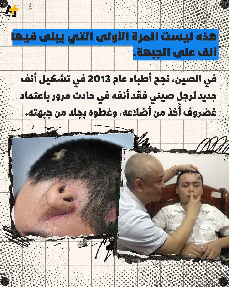 ajplusarabi's tweet photo. عامل فقد 99% من أنفه.. والجراح العراقي ديار عبد الواحد يعيد بناء أنف جديد له، لكن في الجبهة. https://t.co/MvcUqqwc6y