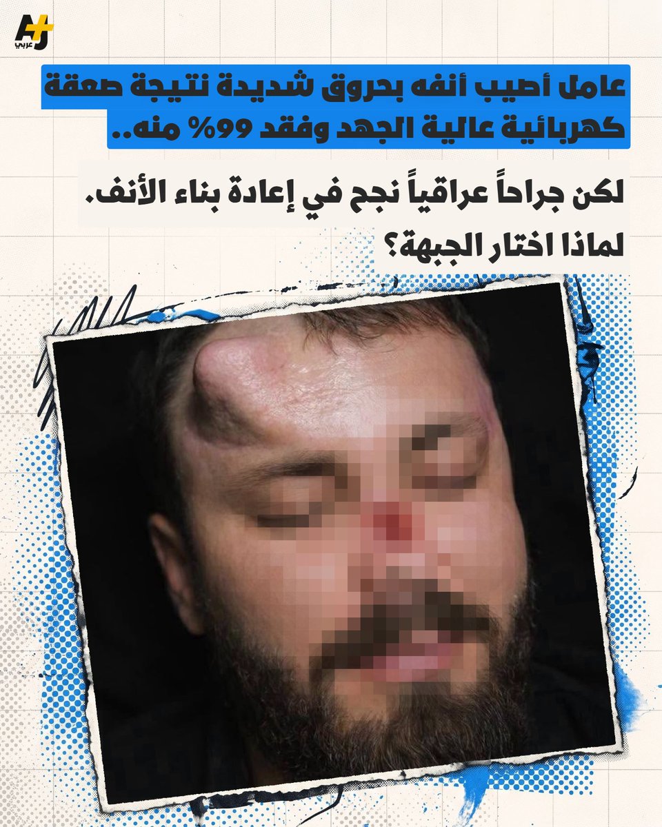 ajplusarabi's tweet photo. عامل فقد 99% من أنفه.. والجراح العراقي ديار عبد الواحد يعيد بناء أنف جديد له، لكن في الجبهة. https://t.co/MvcUqqwc6y