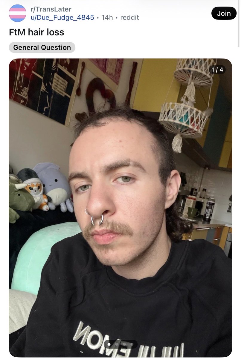 marycatedelvey's tweet photo. A woman took testosterone to pretend she is a man. Now she is upset because she is balding. https://t.co/sfoplZwopZ