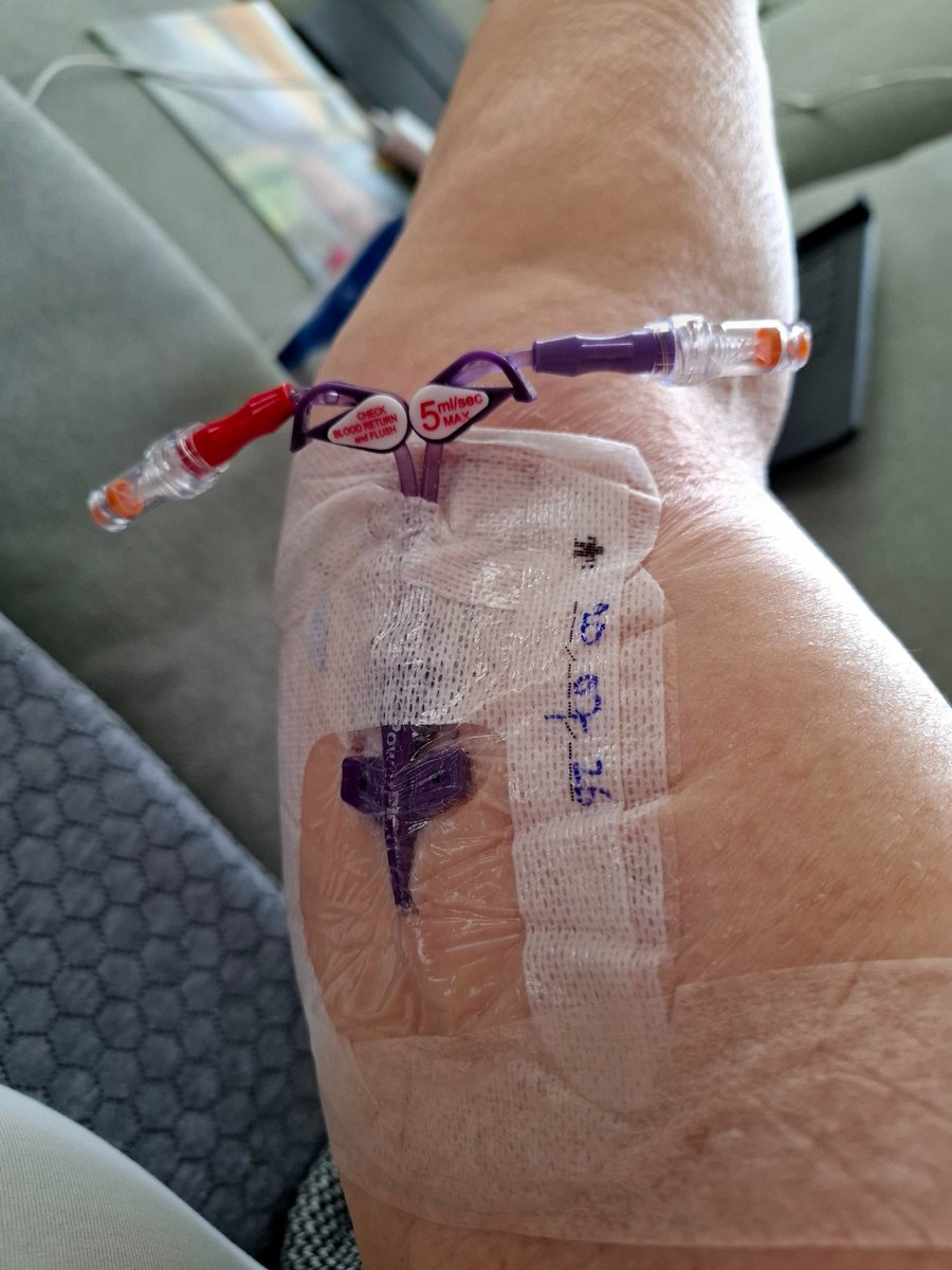 Elisabeth_vdArk's tweet photo. Foto's van mijn Picc-lijn met dubbele Lumen. Eroverheen een mooie cover van @WearToCare zelf betaald.
#eierstokkanker #gedonderinhetvooronder #boek #erasmusmc https://t.co/MdogBdgTuf