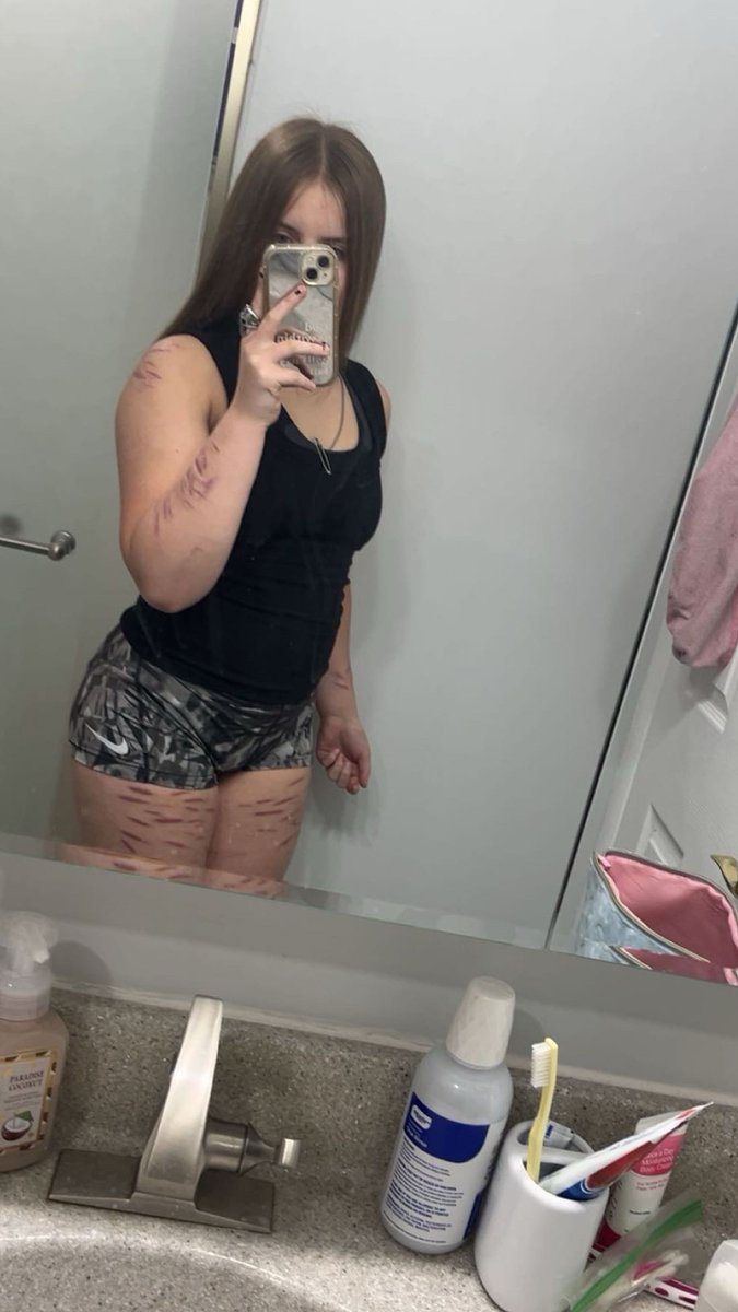 lunatuna3254085's tweet photo. my scarss 💕 (almost 3 months clean 🧼)  :3 #sliceytwt #beanstwt #scarspo? https://t.co/kHDOPjzECC