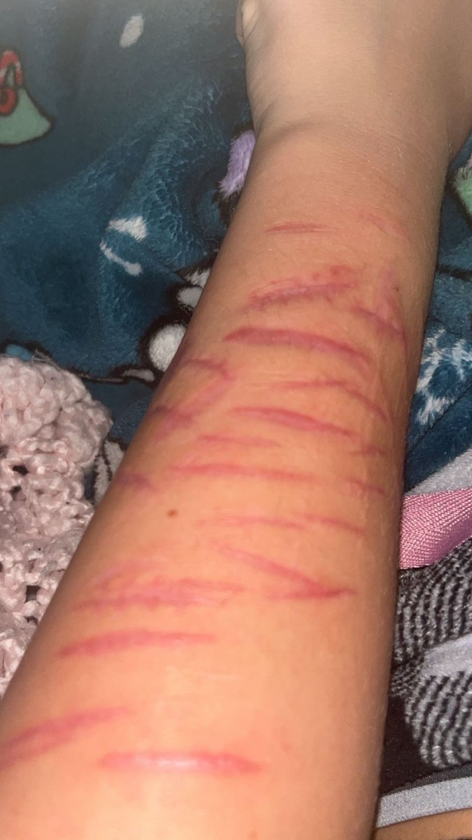 lunatuna3254085's tweet photo. my scarss 💕 (almost 3 months clean 🧼)  :3 #sliceytwt #beanstwt #scarspo? https://t.co/kHDOPjzECC