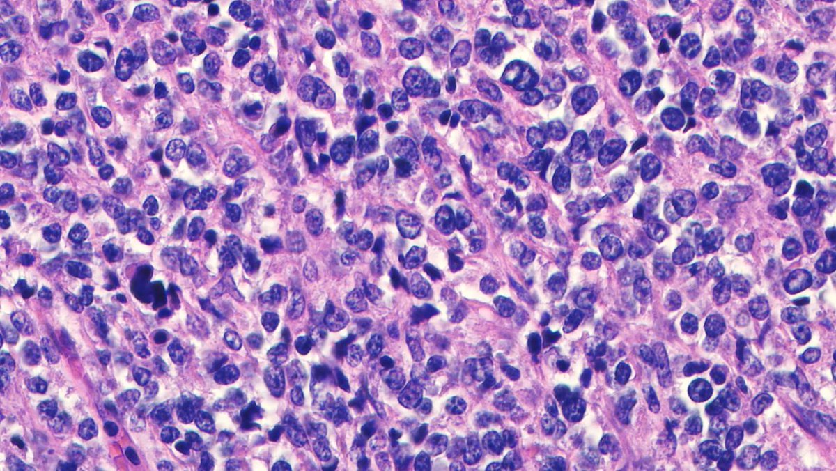 javidiparsijani's tweet photo. Looks pretty convincing for #lymphoma, even has positive #mum1 but it wasn't!! A rare example of #extraskeletal #Ewing #sarcoma. "small, round blue cell tumor". Young man with pelvic mass.
pos: CD99, BCL2, CD56,NKX2.2, mum-1,Fli-1
neg: everything else :-))
#hemepath
#sarcoma https://t.co/vaEwlYH9fN