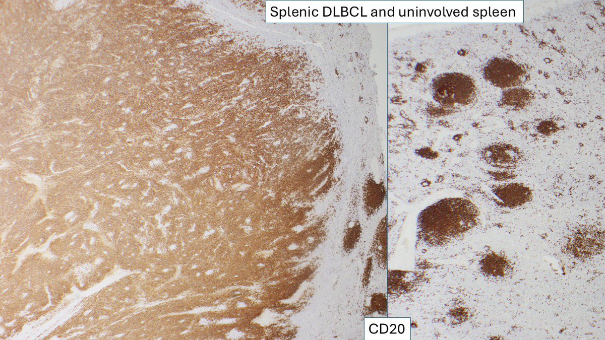 judith_ferry's tweet photo. Pathologists! Can you stand one more splenic B-cell lymphoma? In contrast to low grade splenic BCL, diffuse large BCL usually forms a large discrete mass. There are exceptions, e.g.,T cell/histiocyte rich large BCL may not form a discrete mass. #lymphoma #spleen #hematopathology https://t.co/ySSfdnD6Lr