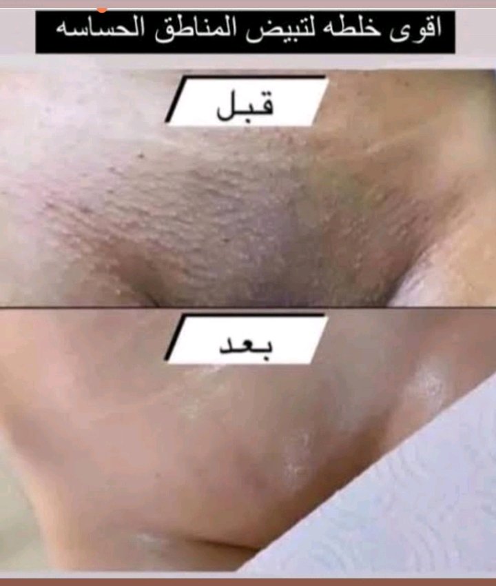 ztobab's tweet photo. اذا عندك اي مشكله ليه اماكن صغيره او غمقان او في العلاقه او في اي شيء احنا مركز مختص نساء فيك الاستفسار على الخاص في اي شيء 🥼🥼 https://t.co/hUrj3R3jJj