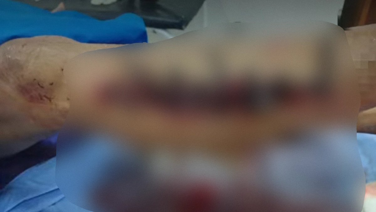delpynews's tweet photo. ▶️ SUTURARON CON CINTILLOS DE PLÁSTICO A ABUELO DE 87 AÑOS | 😳🏥

📌 Un paciente de 87 años fue suturado con cintillos de plástico en el Hospital Distrital de San Estanislao, en San Pedro.

👉Sus familiares denunciaron un caso de negligencia médica.

🗣️La directora del centro asistencial aseguró que no se trató de una falta de insumos, sino de una decisión técnica tomada por el traumatólogo a cargo.

Vía: UH.