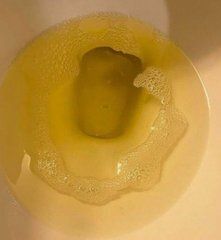 VargasKevi70887's tweet photo. Señales que indican que tienes resistencia a la insulina
(sin darte cuenta)

1. La aparición de espuma al orinar. https://t.co/Hewx4hIynx