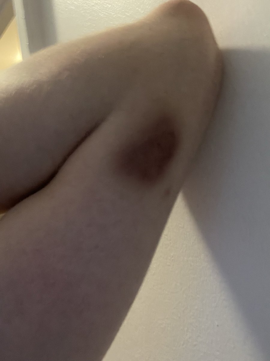 LiamDolanYT's tweet photo. Someone bruise me like this pls x

#nsfw #nsfwtwt https://t.co/CShnUcNEFc