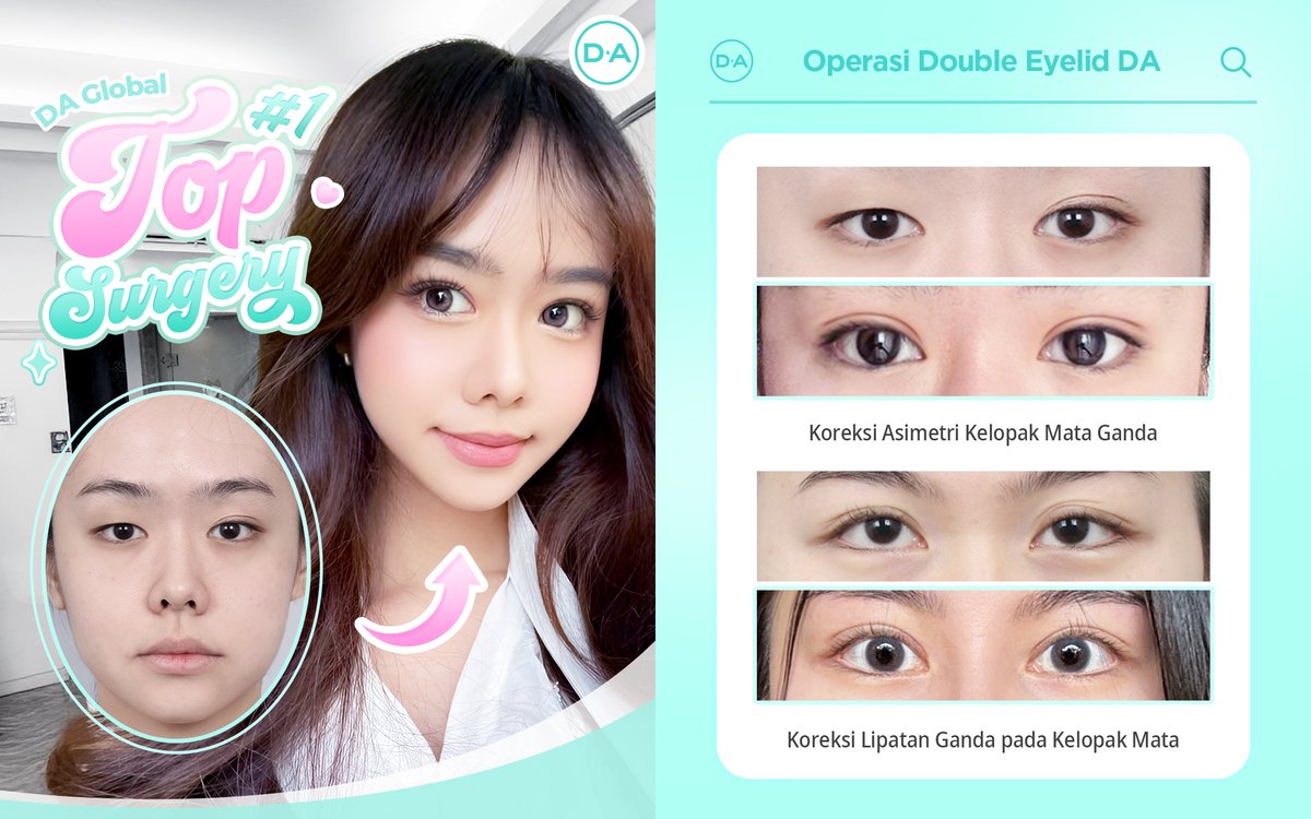 daprs_indo's tweet photo. 👀 Kami siap memberikan solusi operasi mata yang disesuaikan dengan kebutuhanmu! Gak cuma sekedar jelas, tapi juga nyaman dan aman! 😎✨

✅ Mata lebih cakep, lebih tajam, dan pastinya lebih percaya diri! 💯 https://t.co/iuFnLGbpZ4