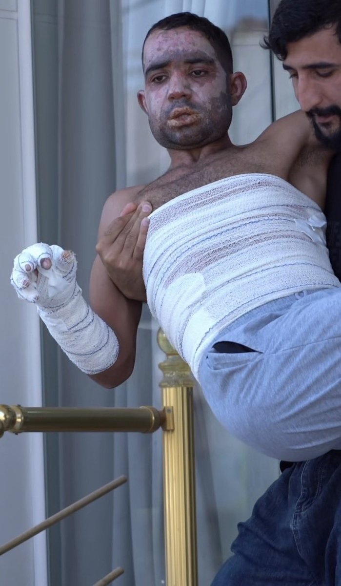 HazhirKvn's tweet photo. Iran’s repeated attacks on the Political Parties of Iranian Kurdistan are war crimes. Injuries to some of @PAKenglishh Peshmergas strongly suggest the use of white phosphorus in the attacks.

#JusticeForKurdistan 
#StopUsingBannedWeaponsInKurdistan https://t.co/qr62mZQDkU