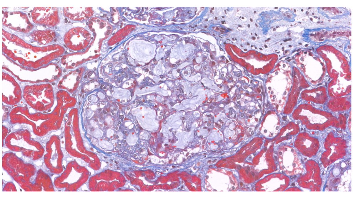 roboonya's tweet photo. Lipoprotein glomerulopathy in 36 yo F. Glomeruli shows dilated capillary lumens filled with lipoprotein thrombi. https://t.co/U0TXuqGzUr