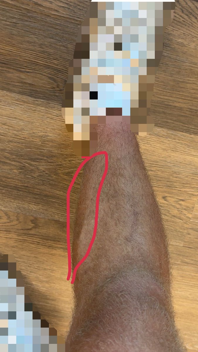 DerekMc34's tweet photo. Thought I was a fat chud until I saw this little bugger poking out of my leg today. Needed to take a picture to remember the moment. #love #stillachud https://t.co/3SpmzY99sQ