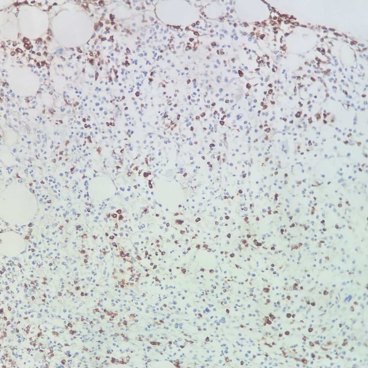 jcksalex's tweet photo. Ki67 (MIB1) is an EXCELLENT benchmark to evaluate how aggressive decalcification was. MPO (left) / Ki67 (right). Hematopoiesis should show ⬆️ Ki67. This is especially valuable for external samples. Do not interpret other antibodies unless you see internal controls for each. https://t.co/fcSj7HouZY