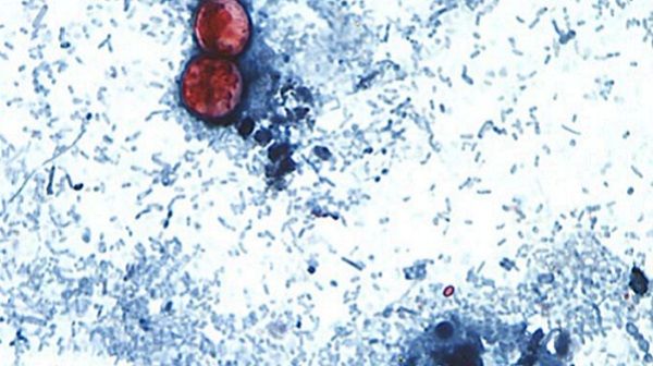 dallasnews's tweet photo. Why the 2026 cyclosporiasis outbreak is worse than previous years https://t.co/aosuVAoCyf https://t.co/ZyC1RPS34N