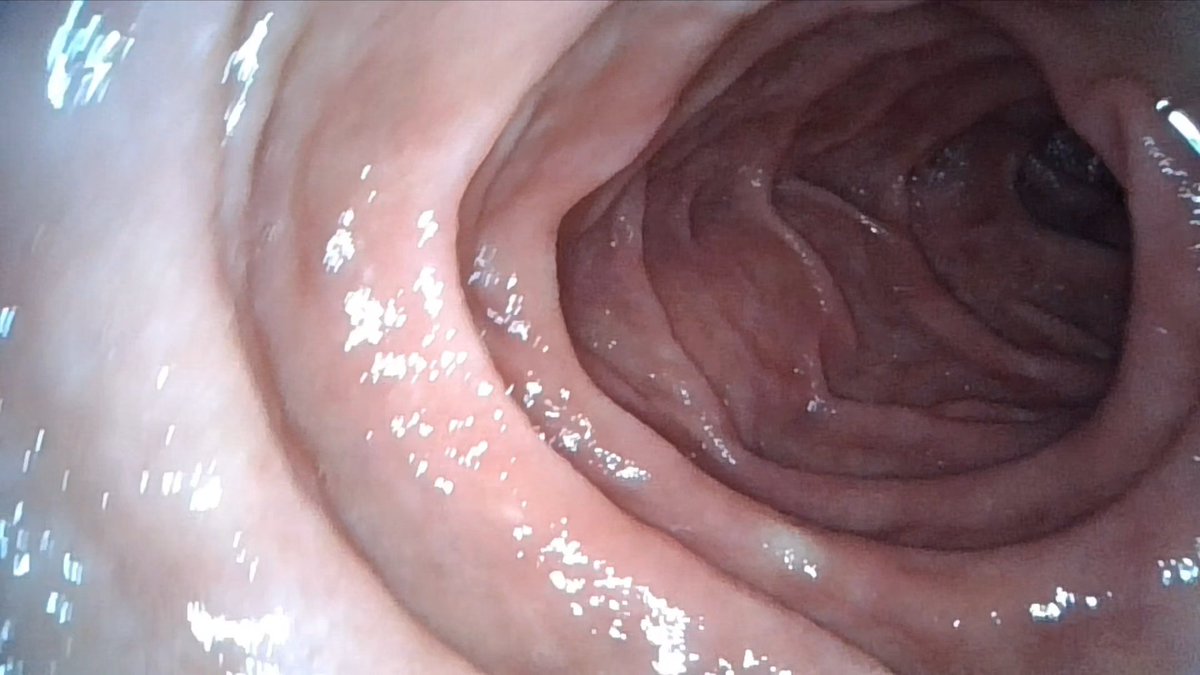 HydraXlame's tweet photo. #endoscope #duodenum #intestine #HD https://t.co/fZ9Si7i6Ld