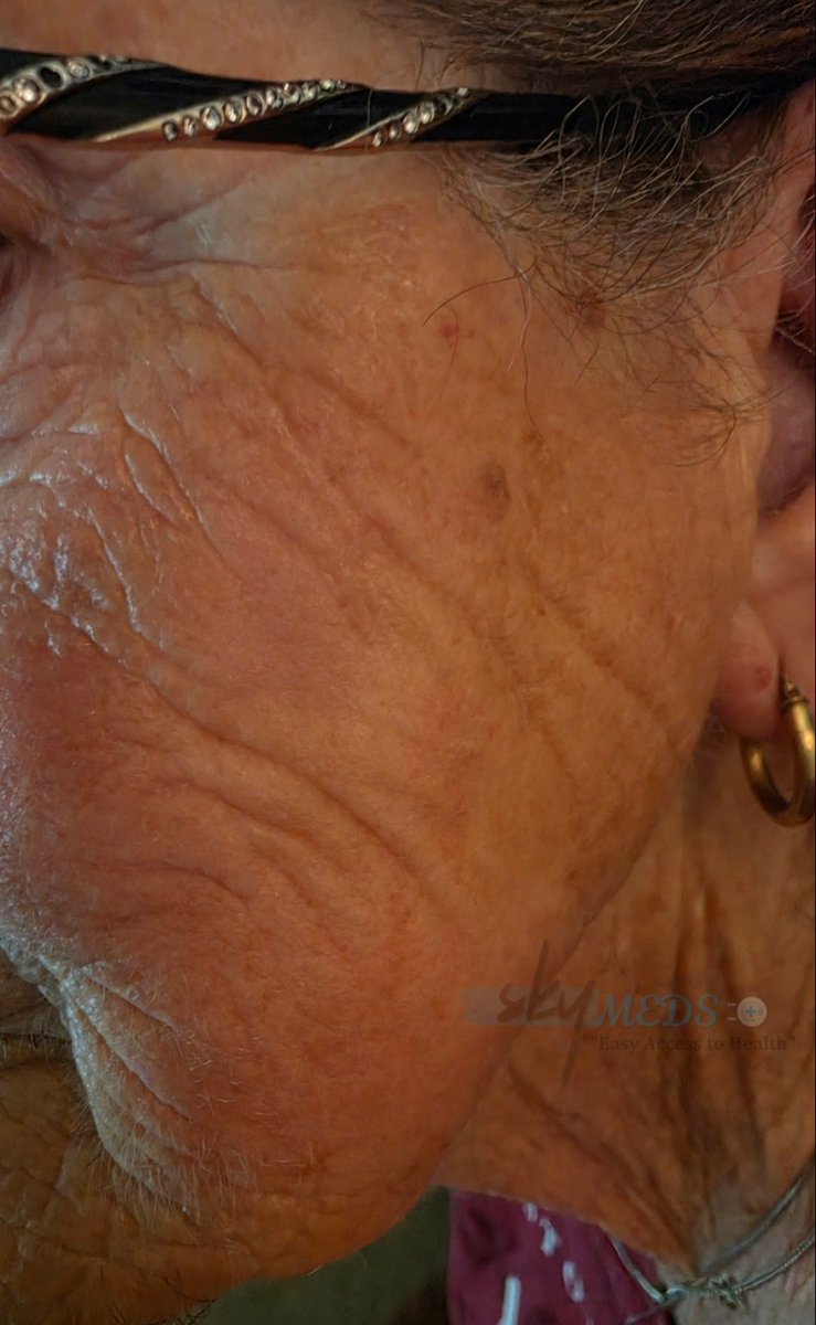 ZakariaMDv3's tweet photo. "Mom has this spot on her cheek. Is the paste safe?"

That was the message from my sister last spring.

She'd noticed a rough, scaly patch on Mom's right cheek. It had been there for months. Growing slowly. The dermatologist said it was "suspicious" and wanted to biopsy it.

Mom was terrified. She's 78. Surgery on her face? No way.

I told her about the Ivermectin paste I'd been researching. She'd heard the jokes. "Isn't that horse stuff?"

I said, "Just try it on a tiny area first. Patch test."

She did. Two days, nothing. Then she started applying a pea-sized dab every morning and night.

Week 1: The redness started fading. She said it felt less itchy.

Week 2: The scaly patch began drying up. A crust formed. She was nervous – but I told her that was part of the process.

Week 3: The crust fell off. Underneath was smooth, healthy skin. Just a faint pink mark.

Week 4: The spot was completely gone. No scar. No surgery. No biopsy.

She called me crying. "It's gone. I can't believe it."

I can't either. But I've seen it now.
