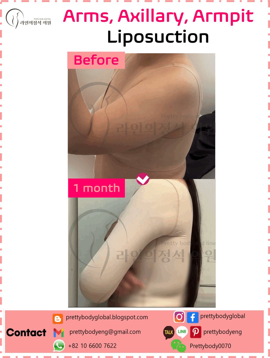 ClinicEng's tweet photo. #Armliposuction #operasiplastik #slimarm #breastaccessary #bestliposuctioninseoul #plasticsurgeryinkorea #liposuctioninkorea #abdomenliposuction #bodysculpting #bodycontouring #bodygoal #bodyfit #fitness https://t.co/MhRVLUQEsQ