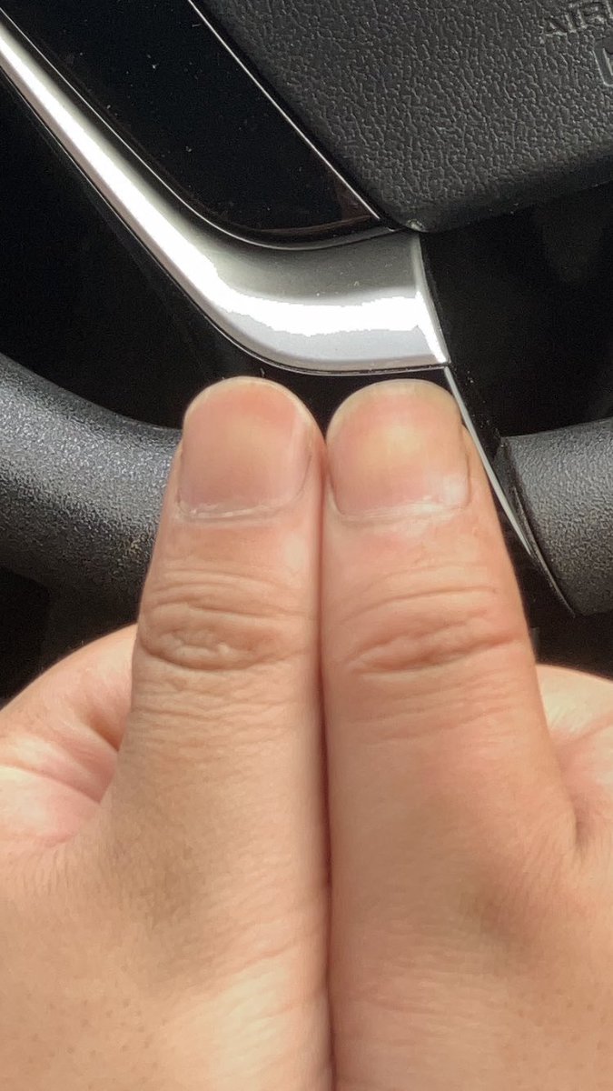 a_kemc's tweet photo. 指までデブいから分かりづらいけど確実に腫れとる。
なんだったら右腕だっる。 https://t.co/7NYvcDYv6e