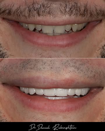 DrDanielSmiles's tweet photo. Your smile is one of the first things people notice 🦷✨

A natural-looking transformation, designed specifically for you. 

Ready to love your smile? Book your consultation TODAY 📅😁

#SmileTransformation #Veneers #NYCDentist https://t.co/Dwqc6pxaNt
