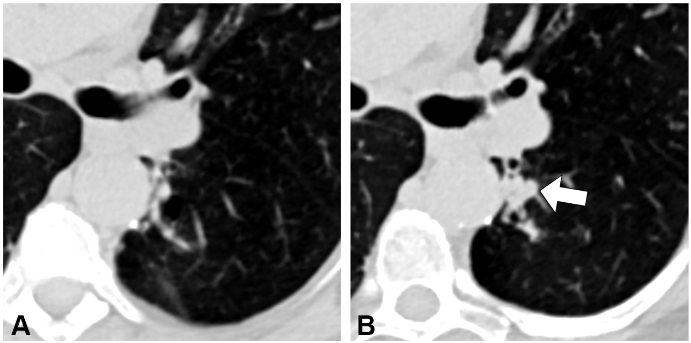 radiologiatorax's tweet photo. Muy buen artículo en @RadioGraphics que describe la variedad de apariencias del cáncer de pulmón recurrente tras el tratamiento definitivo https://t.co/Eg6nEYsAOL https://t.co/BIaHvnSItu