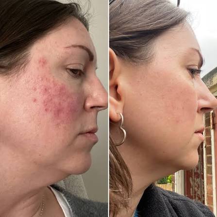 rxmeds_store's tweet photo. 🚨 "My skin finally feels like mine again."

For years, I battled stubborn rosacea.

🔴 Constant redness.

🔴 Painful bumps.

🔴 Persistent irritation.

No matter what I tried, my skin never seemed to calm down.

Every mirror reminded me of it.

Every outing meant reaching for makeup just to feel comfortable.

I tried every cream, diet change, and prescription my dermatologist recommended.

Nothing delivered lasting results.

📌 Then I started using topical Ivermectin cream.

Within just a few weeks, something changed.

✅ The redness began to fade.

✅ The bumps started flattening.

✅ My skin finally began to calm down.

Now, months later, my complexion is clearer and more even than it has been in over a decade.

For the first time in years...

I can leave the house without layers of makeup and actually feel confident in my own skin.

I never imagined something so simple could make such a meaningful difference.

If you're struggling with rosacea, persistent facial redness, or similar inflammatory skin conditions, this is a conversation worth having with your healthcare professional to see whether topical Ivermectin might be an appropriate option.

More people are also seeking pharmaceutical-grade topical Ivermectin formulations rather than over-the-counter lice products intended for a different use.

💊 Looking for pharmaceutical-grade Ivermectin Cream? @rxmeds_store offers trusted products with worldwide delivery.

📌 Save this if you're on your own skin-healing journey.

🔁 Share this with someone who's been battling rosacea or persistent facial redness. It might be the encouragement they need today.

#Ivermectin #Rosacea #SkinHealing #TopicalIvermectin #SkinJourney #HealthySkin #Skincare #Inflammation