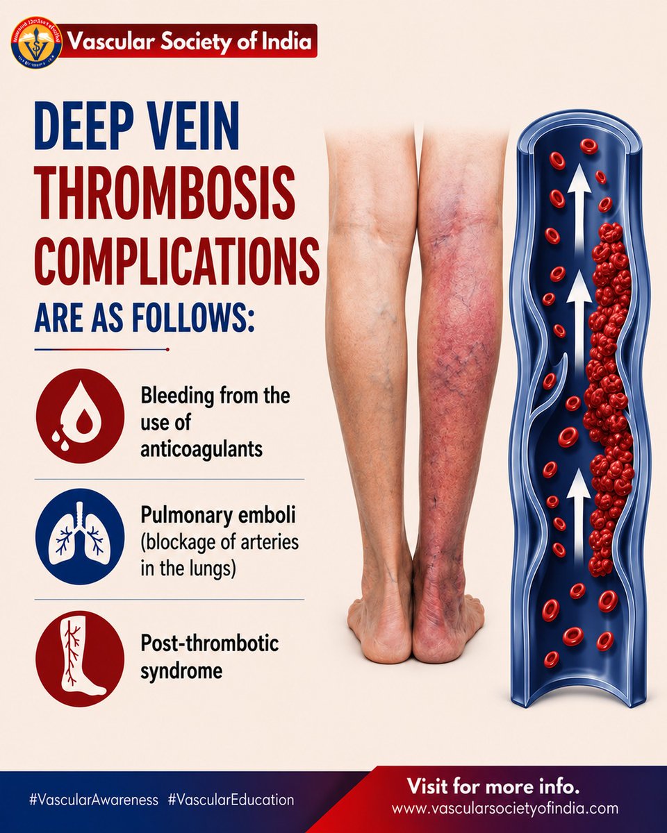 Vascular_India's tweet photo. Deep Vein Thrombosis (DVT) is more than just a blood clot—it can lead to serious complications if left untreated.
🌐 Learn more: https://t.co/wzGO6d6YDK
#VascularAwarenessWeek #DeepVeinThrombosis #DVT #VascularHealth #BloodClots #PulmonaryEmbolism #PostThromboticSyndrome https://t.co/Hmdquqnerr